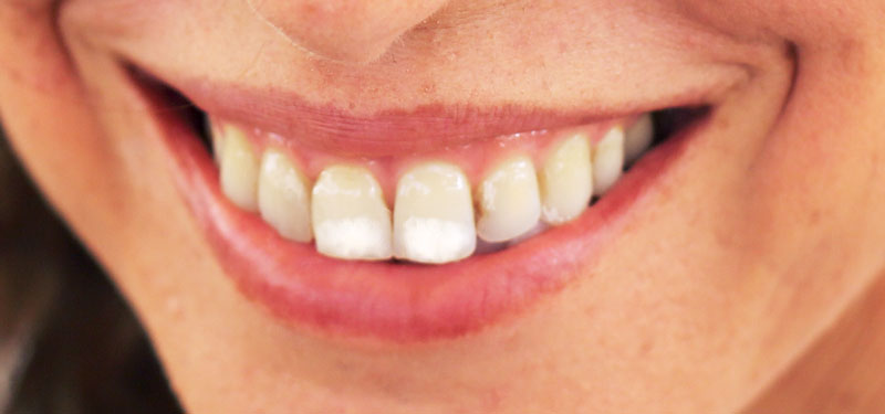 Dientes de Carmen con manchas blanquecinas.