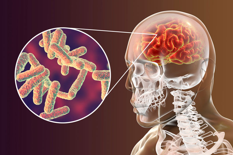 Ilustración 3D de infección del cerebro por meningitis