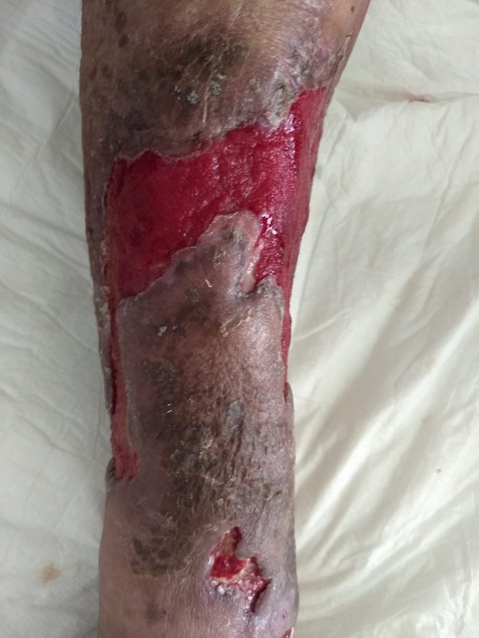 Lesiones ocasionadas por el proceso de necrosis y la intoxicación del veneno de Loxosceles sp.
