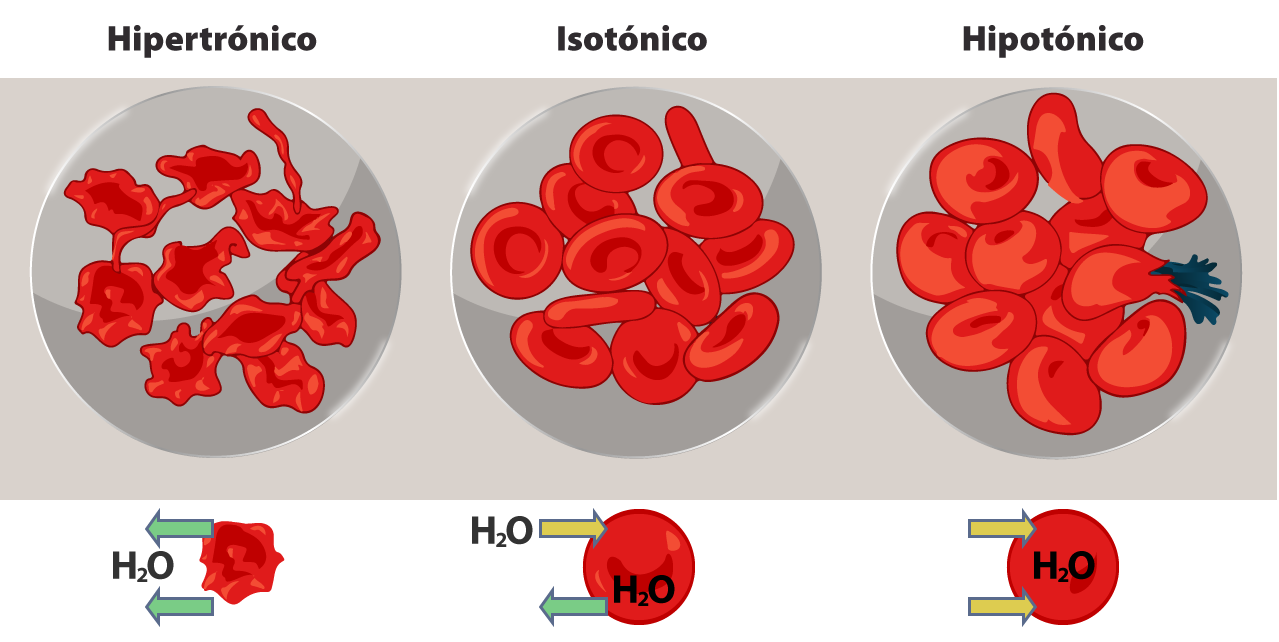 Esquema donde se muestra el flujo de agua en un glóbulo rojo estando en una solución hipertónica.