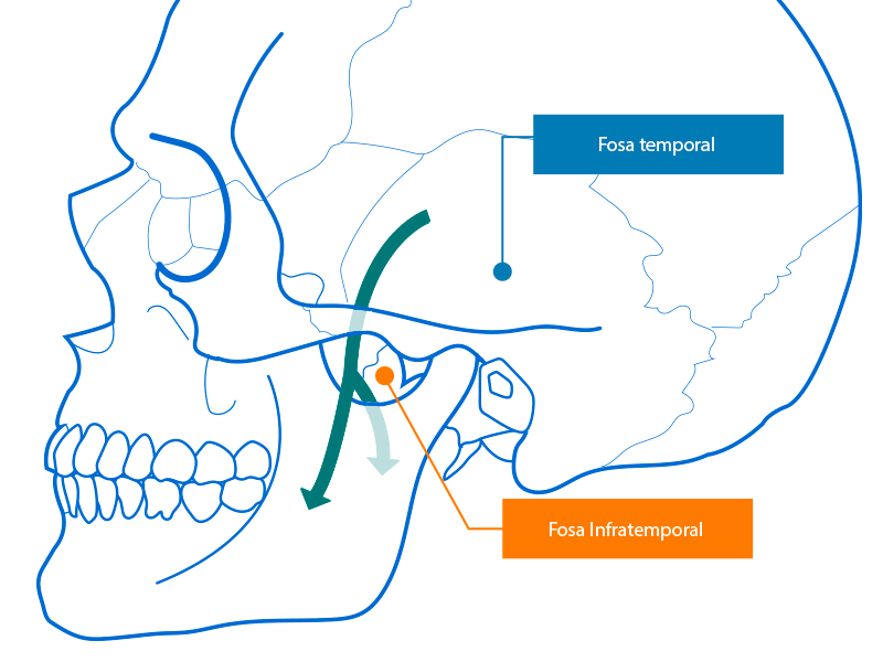 Cráneo en donde se aprecian los huesos de la fosa temporal y su comunicación con la fosa infratemporal.