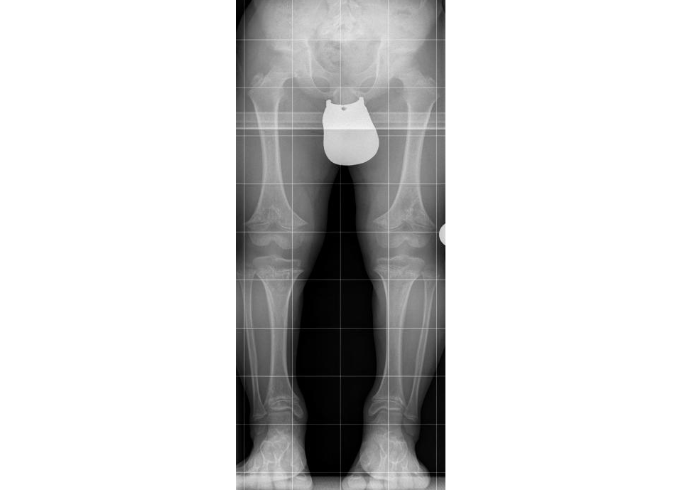 Paciente de 10 años con acondroplasia