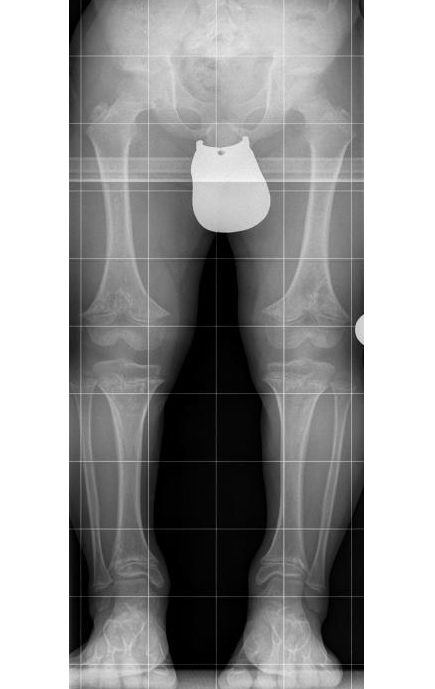 Radiografía de paciente con acondroplasia