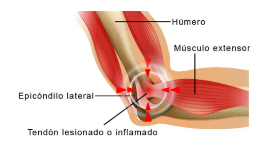 Brazo con epicondilitis.