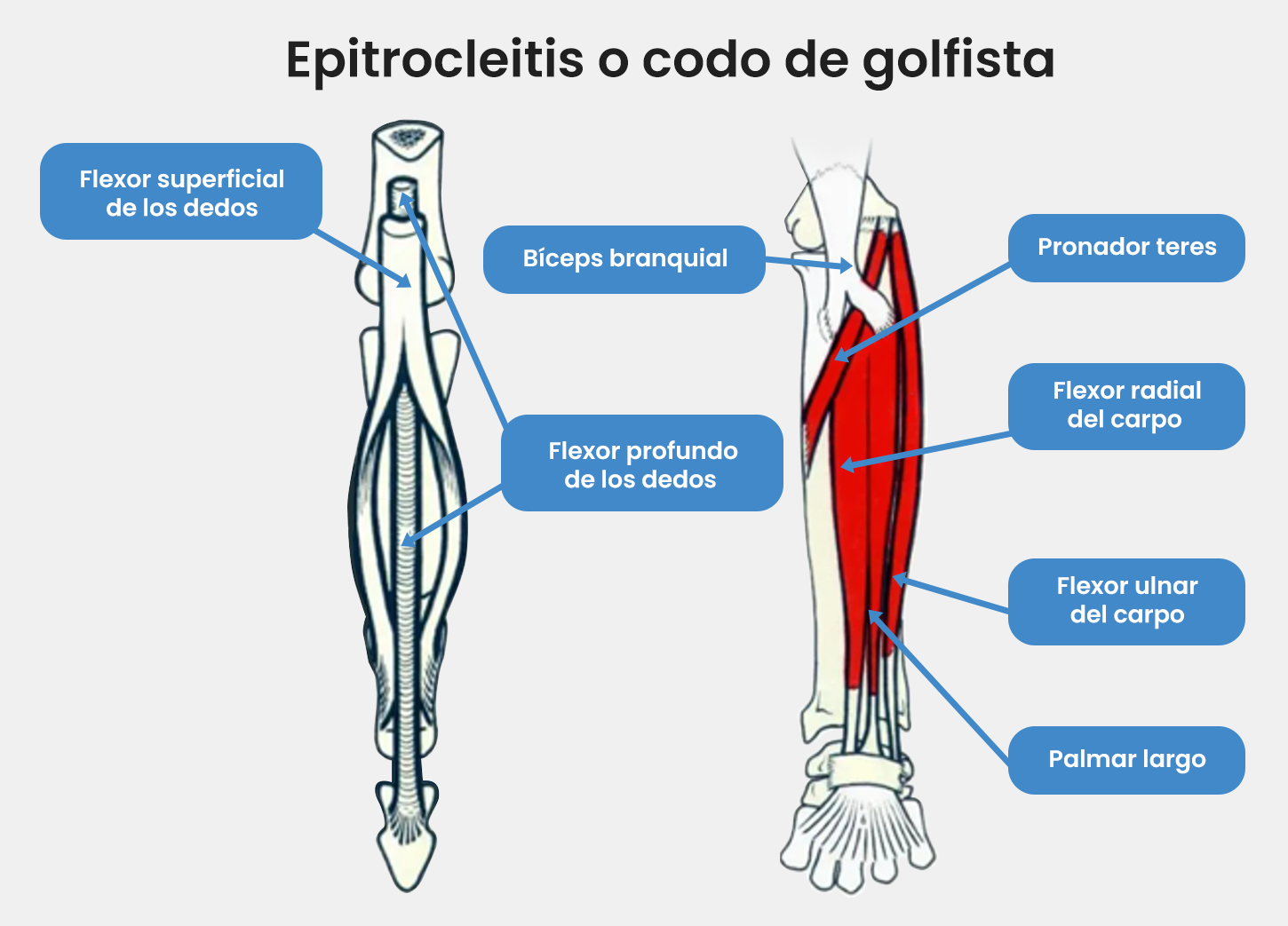 Ilustración que muestra lesión en el brazo.