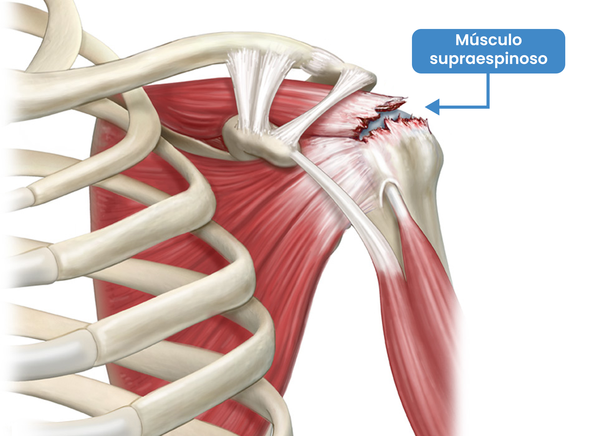 Ilustración que muestra lesión en el músculo supraespinoso. 