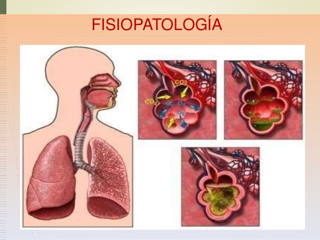 Fisiopatología de la neumonía